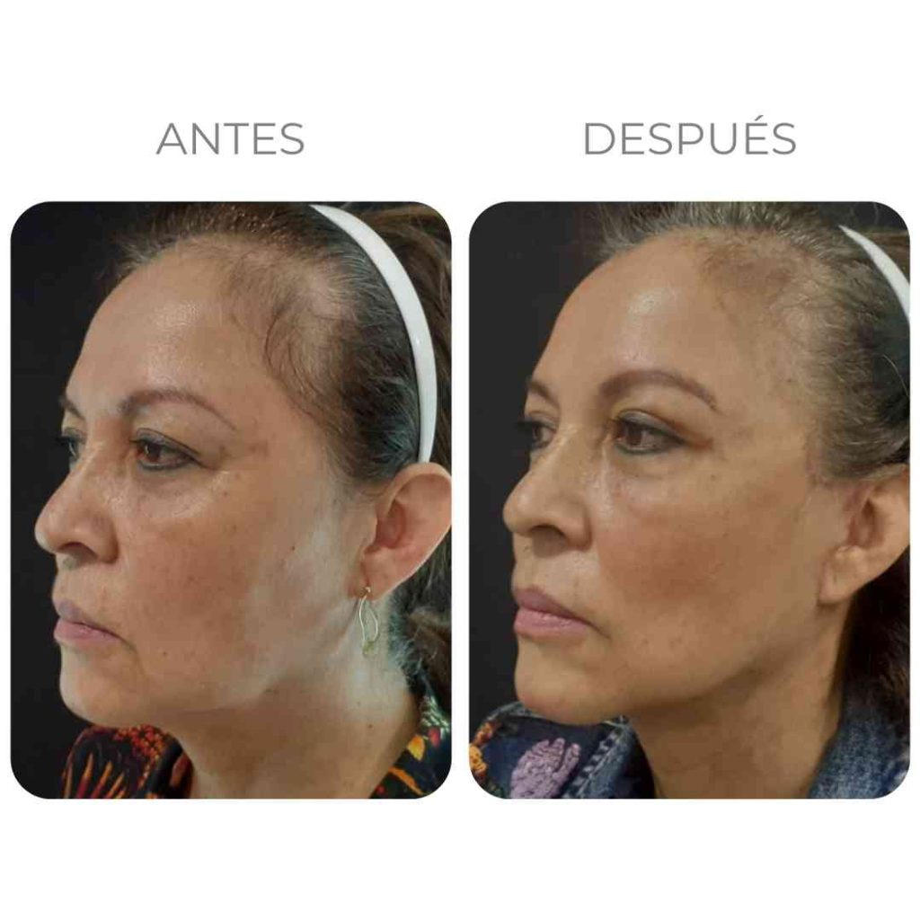 EYEROLL™ – Roll-On Caracol