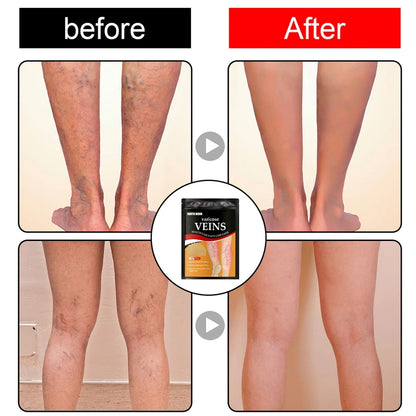 VARIPATCH™ – Parches para Varices